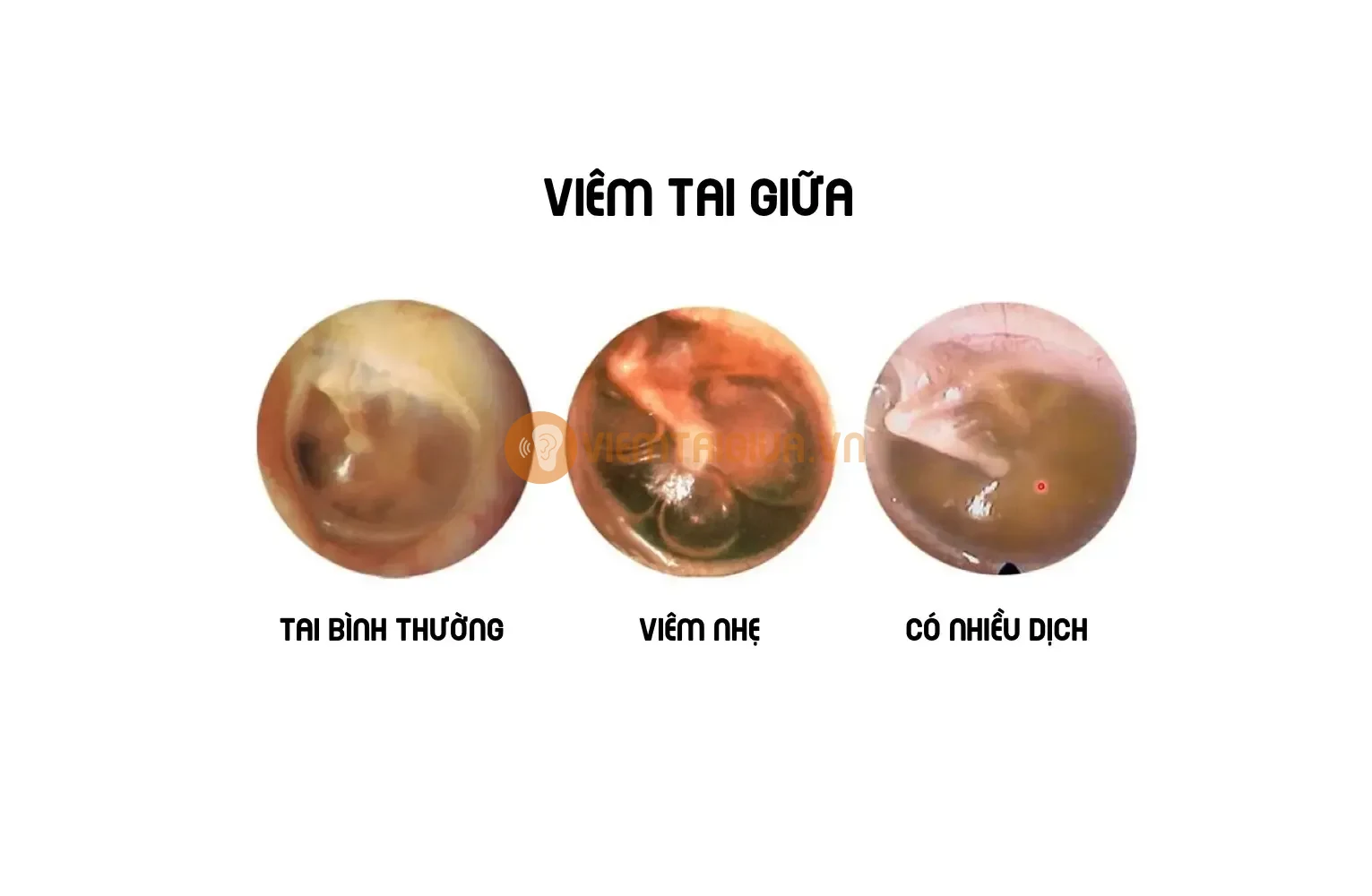 Viêm tai giữa là gì?