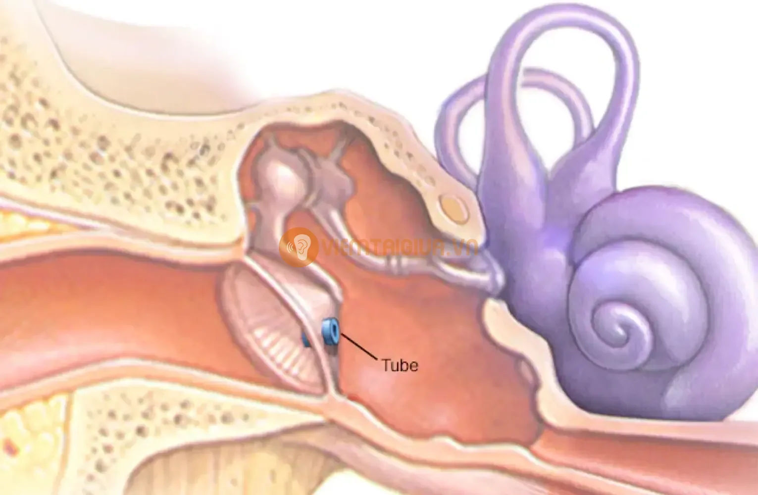 Đặt ống thông nhĩ điều trị viêm tai giữa