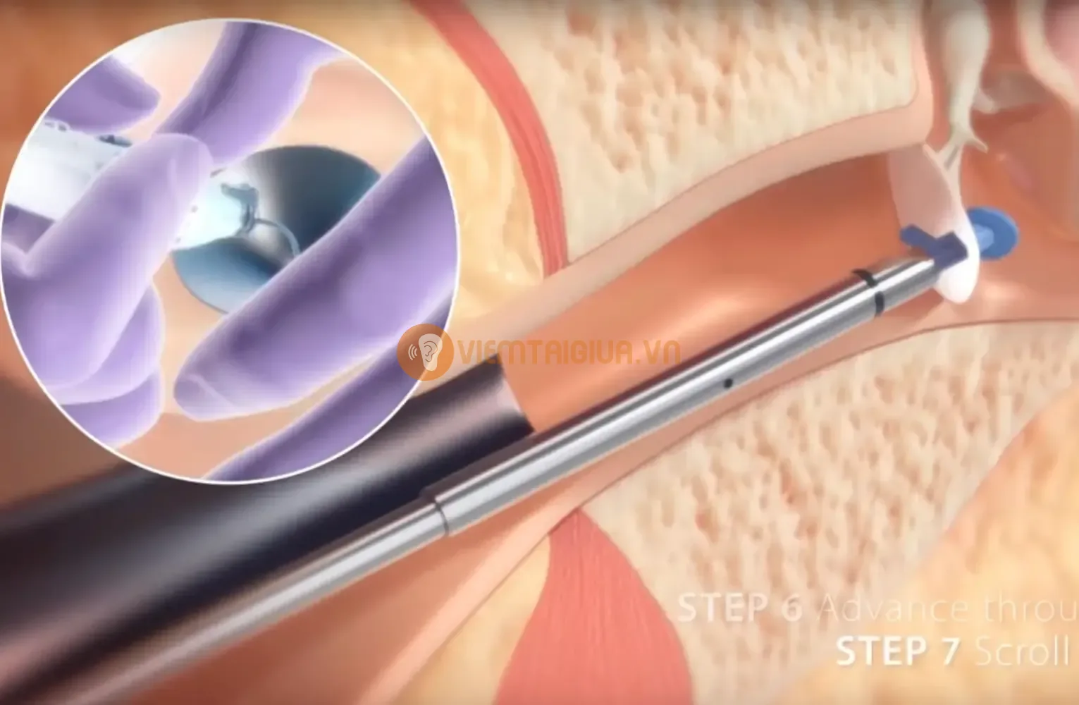 Thủ thuật đặt ống thông nhĩ viêm tai giữa