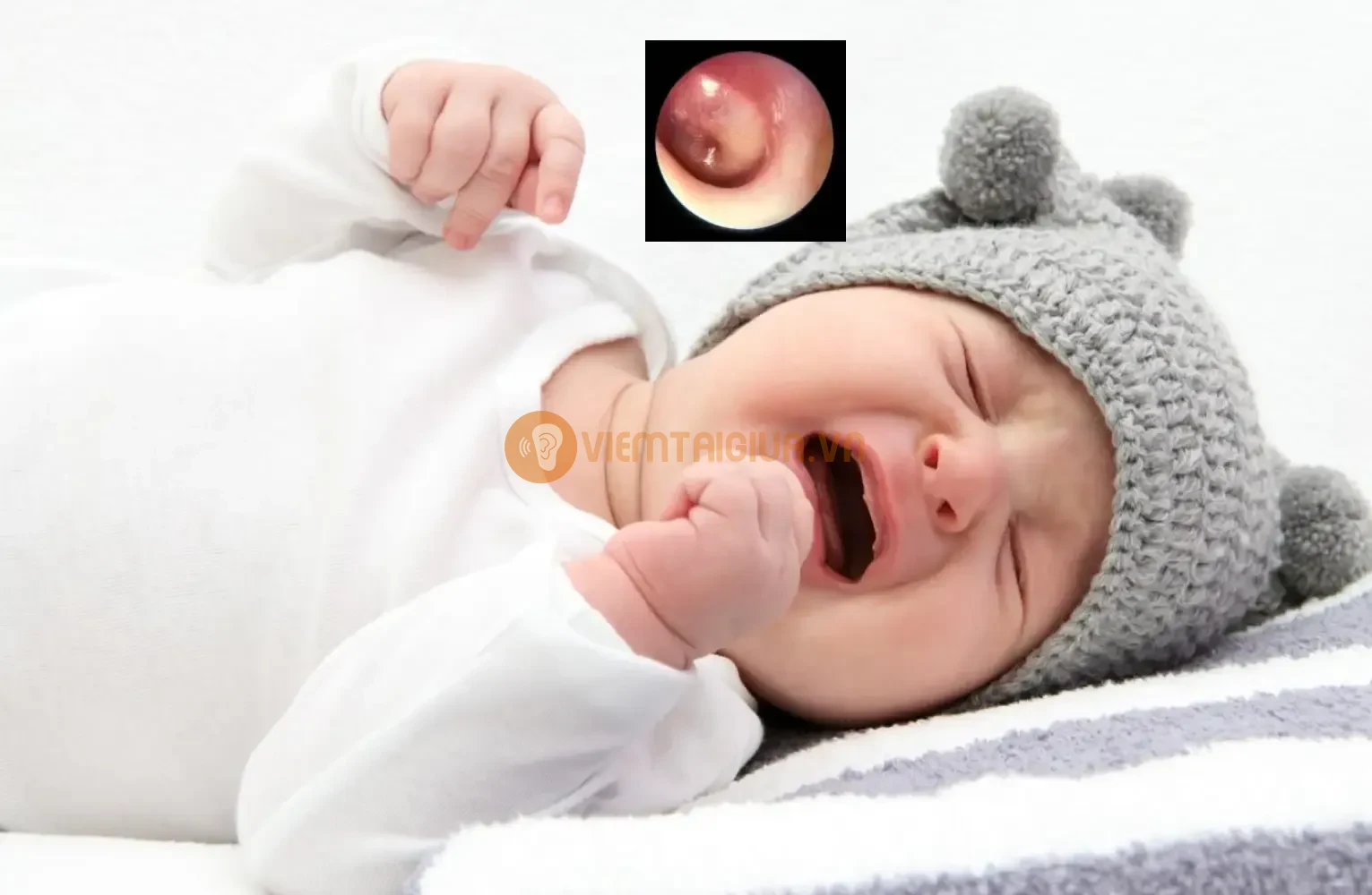 Tại sao viêm tai giữa ở trẻ tái phát nhiều lần?