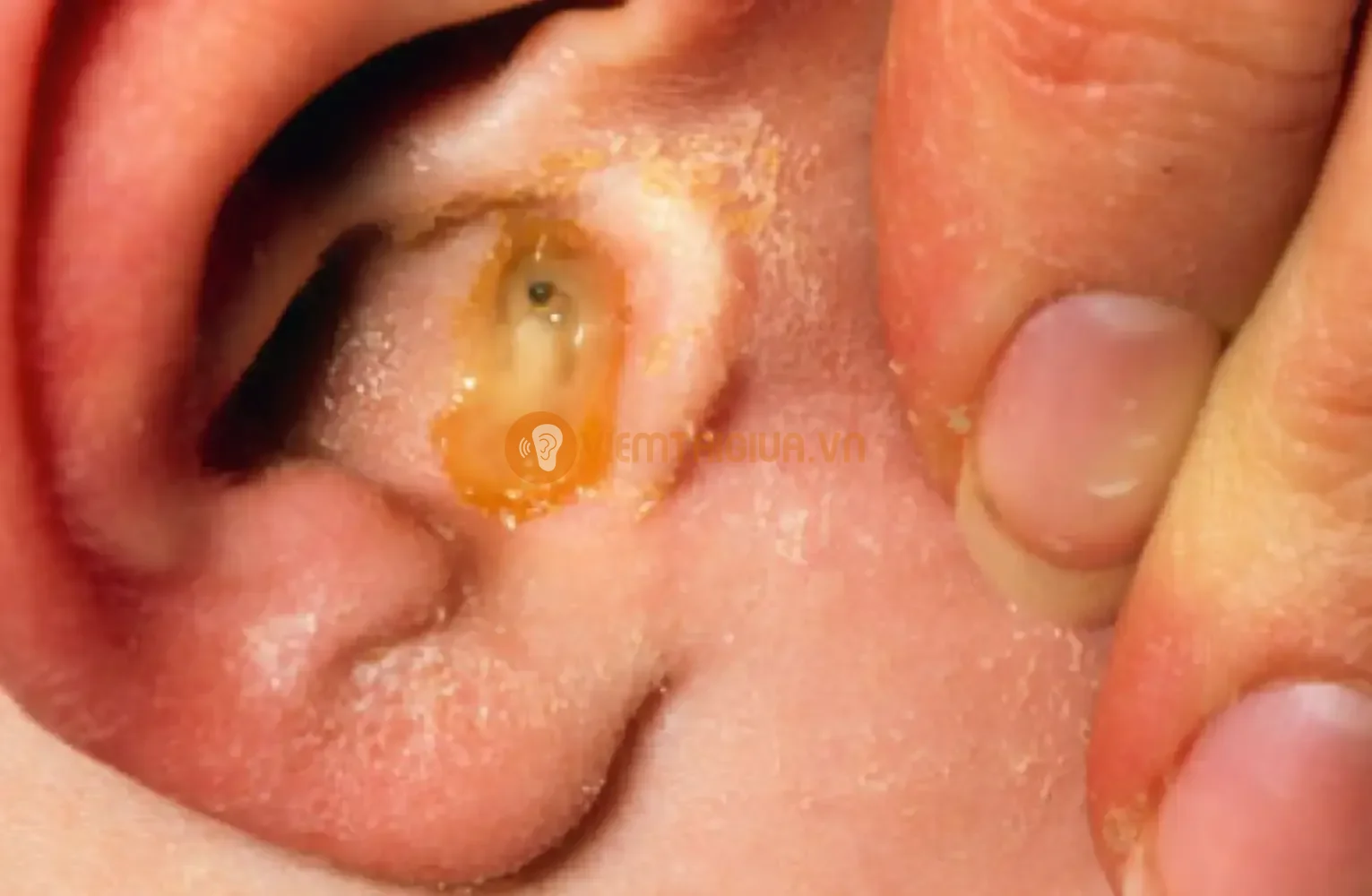 Chất nhầy chảy ra từ tai có thể do viêm tai giữa gây thủng màng nhĩ