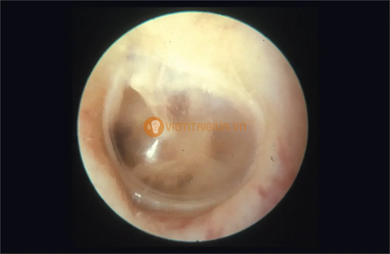 Nguy cơ nhiễm trùng trở nặng khi nước vào tai