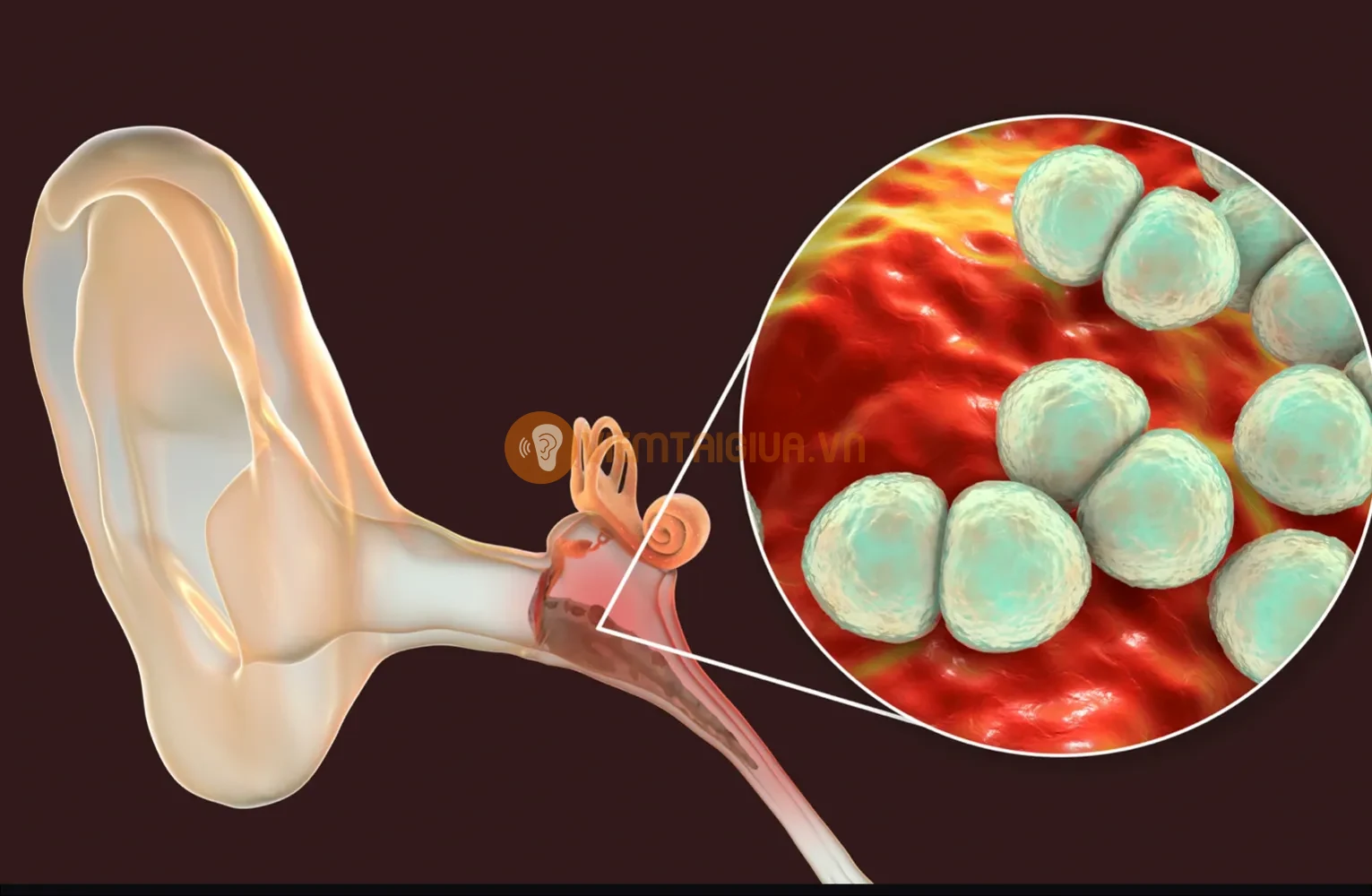 Vi khuẩn trong khu vực tai dẫn tới viêm tai giữa
