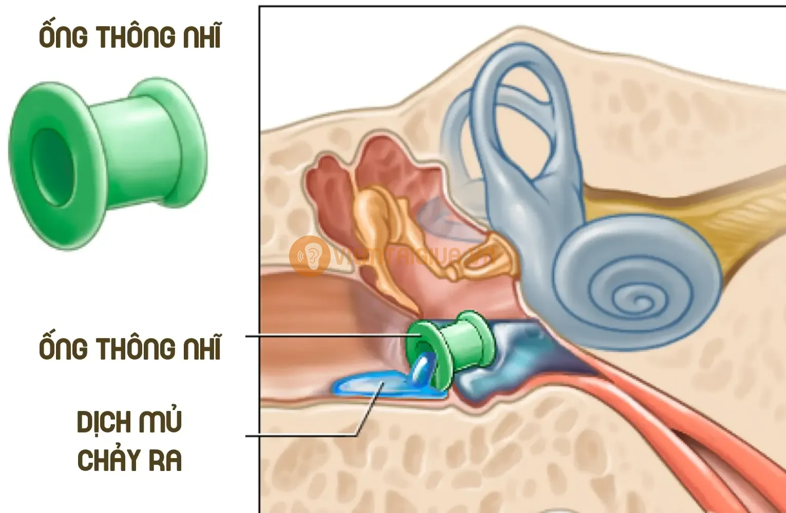 Ngoài chọc mủ, bác sỹ còn có thể đặt ống thống nhĩ giúp mủ thoát ra