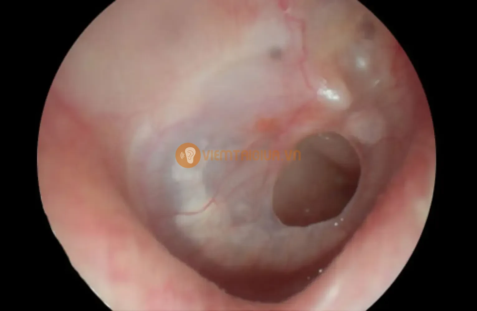 Viêm tai giữa tái phát nhiều lần làm màng nhỉ mỏng đi và dễ thủng