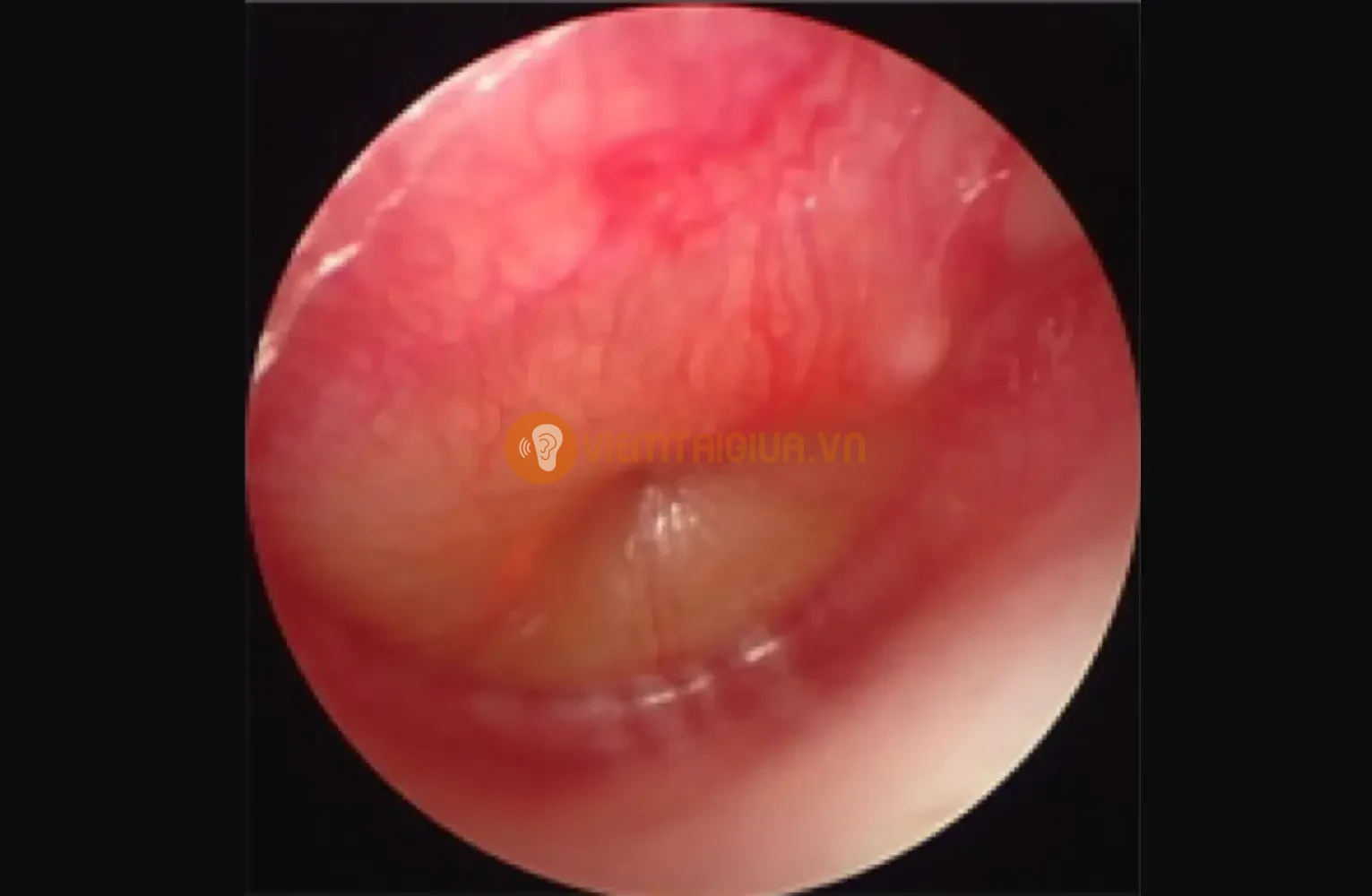 Viêm tai giữa cấp tính AOM với các sọc máu đỏ