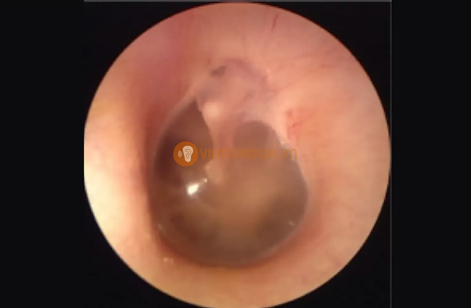 Viêm tai giữa hoại tử ác tính NOE