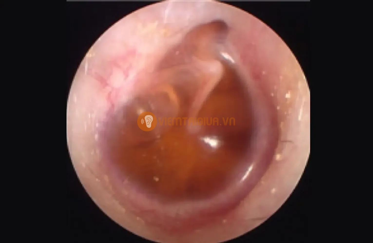 Viêm tai giữa tràn dịch với lượng lớn dịch mủ trong tai giữa