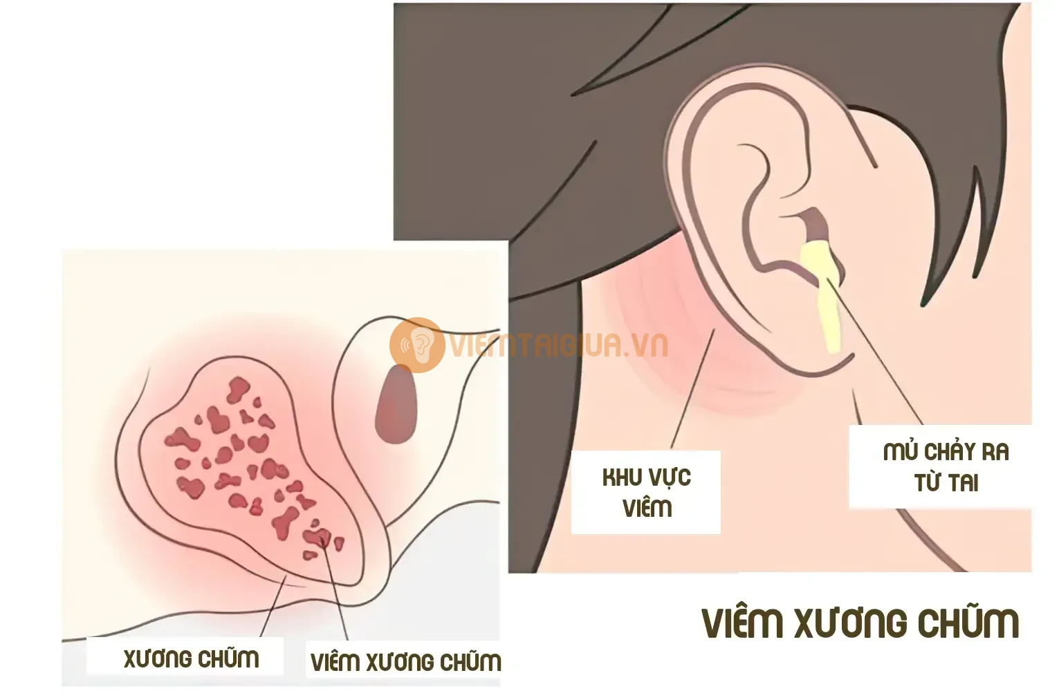 Trực quan viêm xương chũm