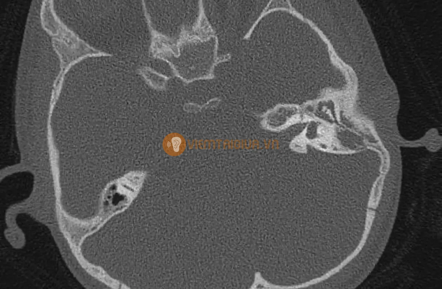 Một trong những biến chứng nguy hiểm của viêm xương chũm là viêm màng não