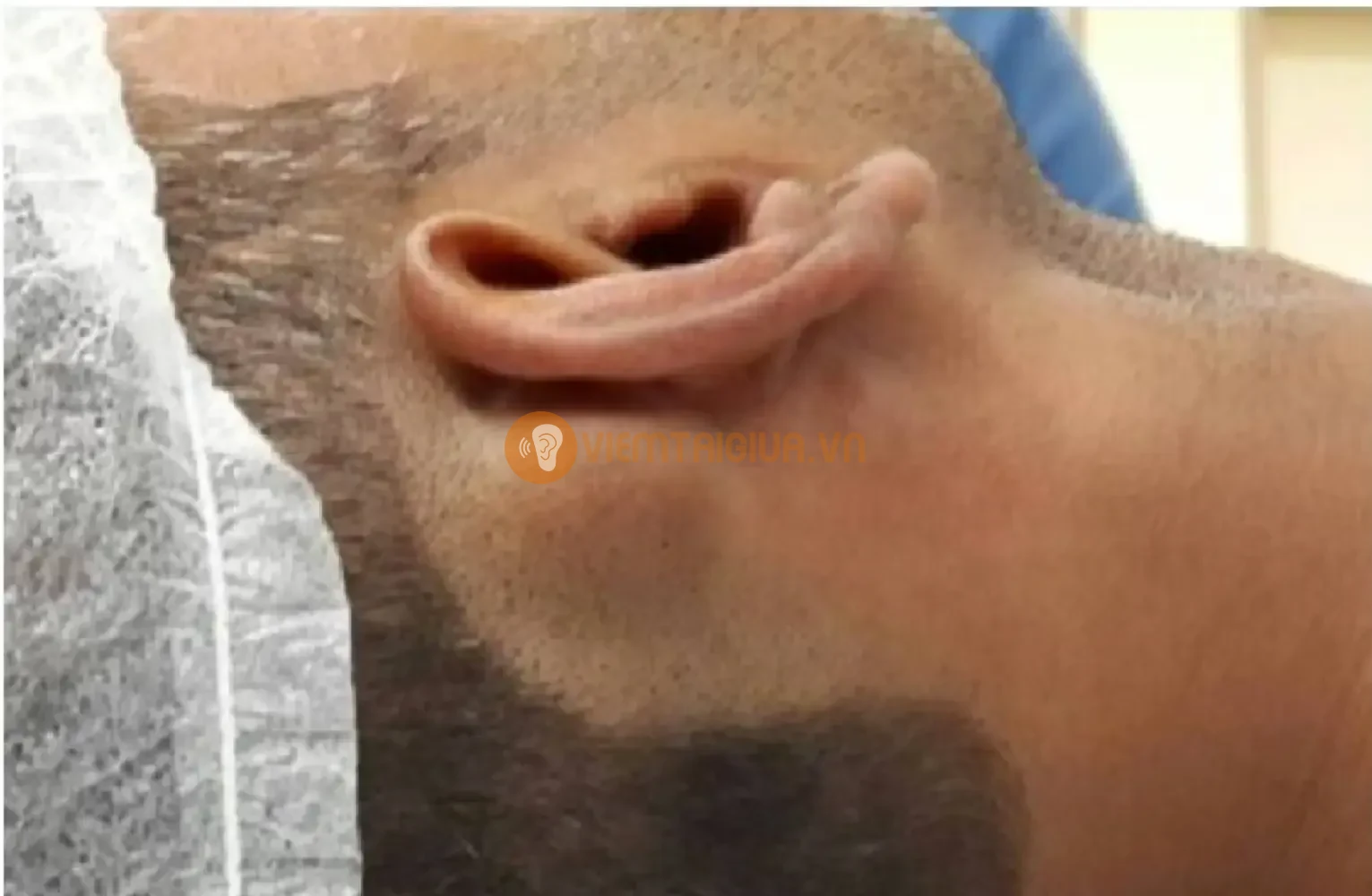 Viêm xương chũm ở người lớn với vùng xương sau tai sưng to