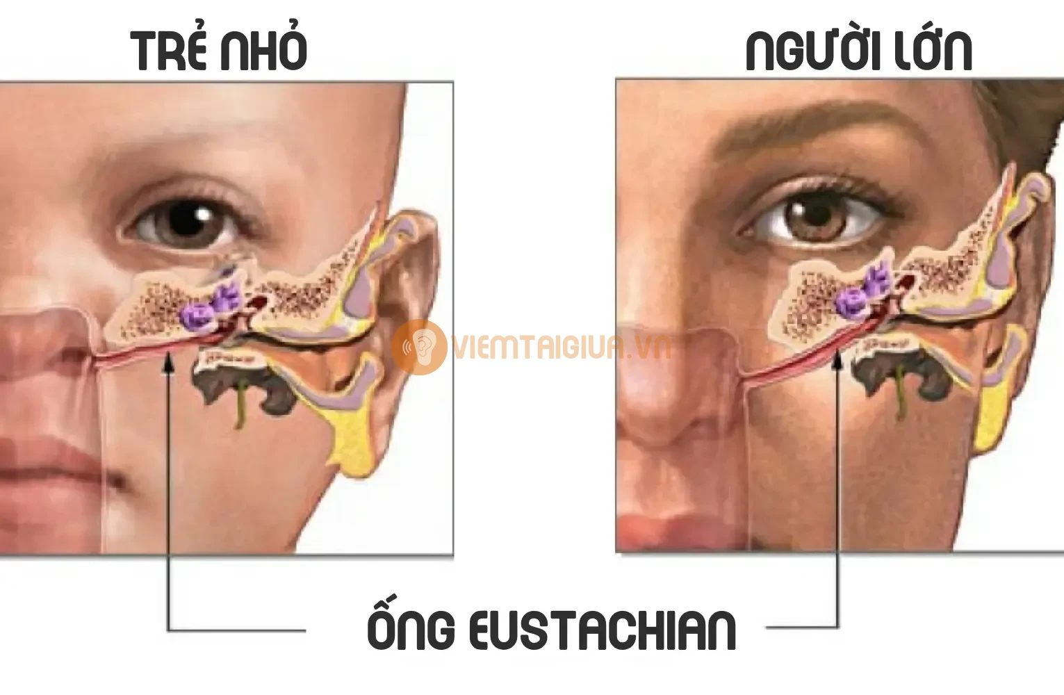 Có nhiều mối liên hệ giữa bú nằm và viêm tai giữa