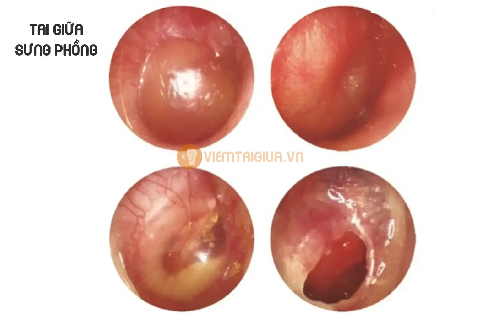 Giai đoạn khởi phát viêm tai giữa
