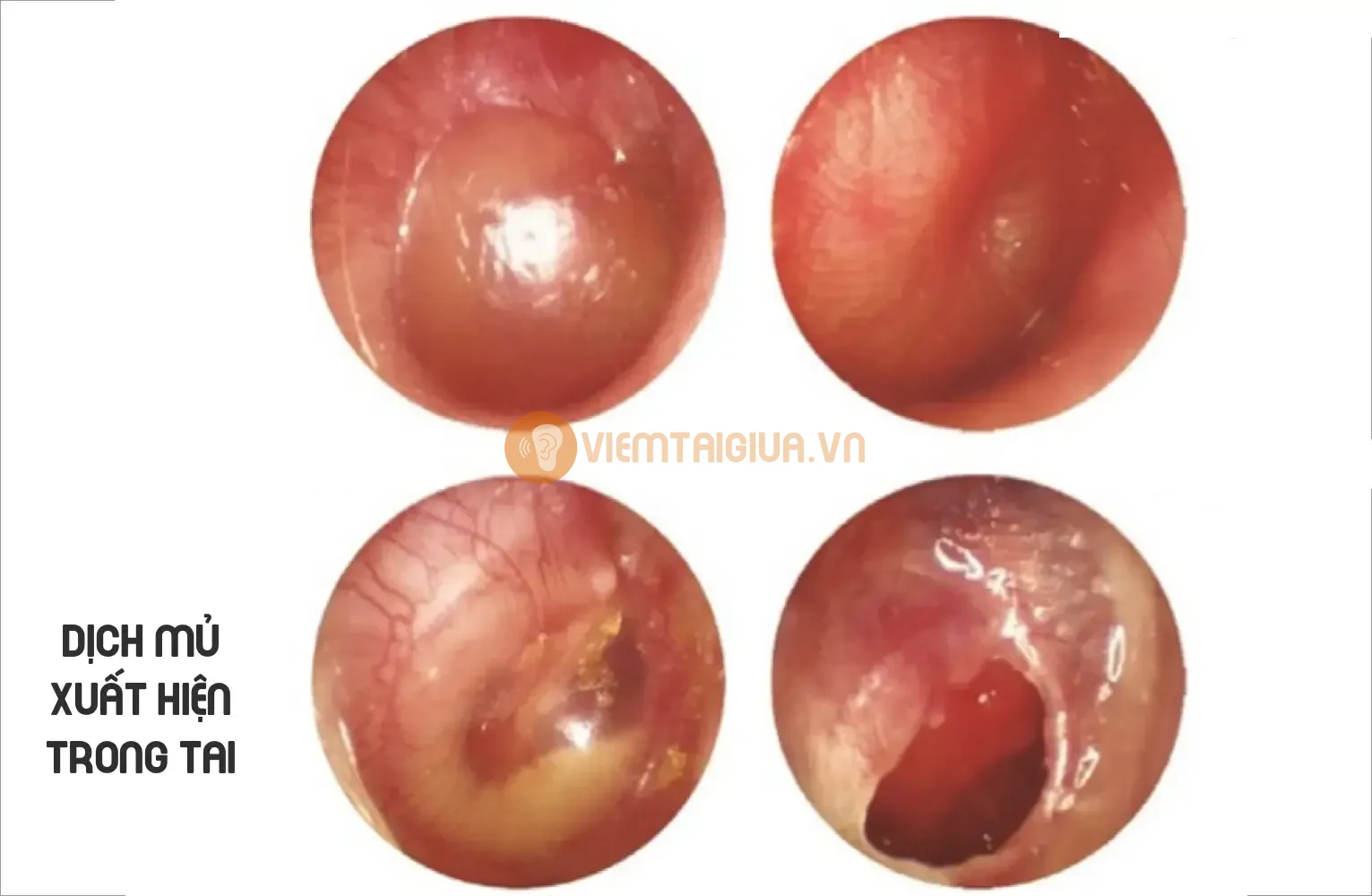 Giai đoạn bùng phát viêm tai giữa cấp cần can thiệp kịp thời