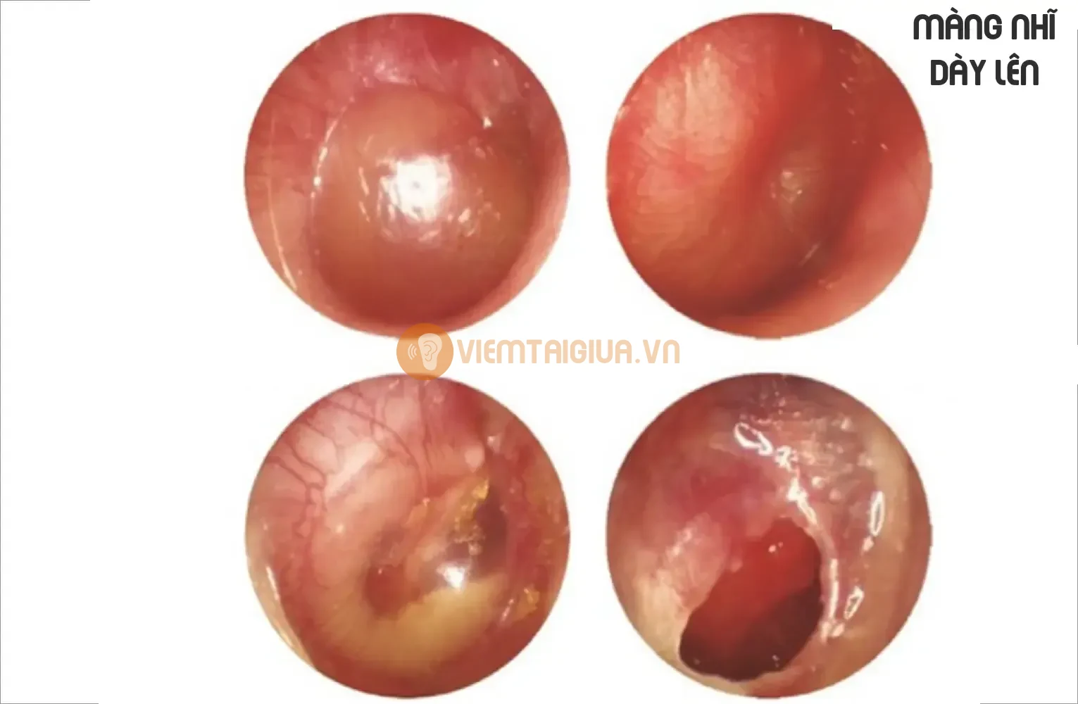Giai đoạn bùng phát mủ xuất hiện nhiều, màng nhĩ sưng to