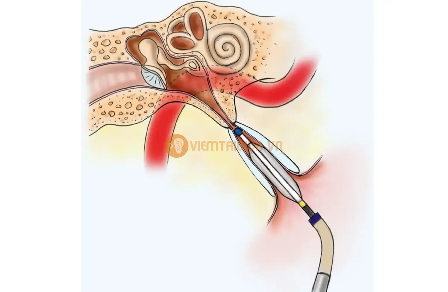 Một trong các phương án điều trị viêm ống Eustachian - đặt ống thông từ mũi