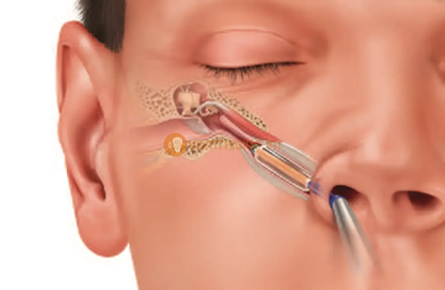 Khi dung dịch rửa mũi di chuyển đến ống Eustachian làm ứ dịch và gây nhiễm trùng tai giữa