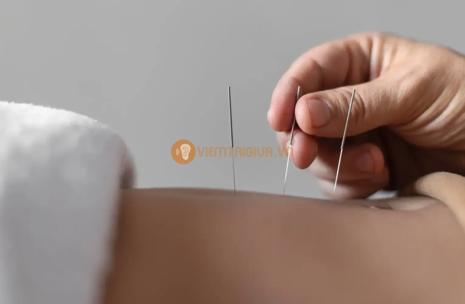 Ngoài sử dụng thuốc, châm cứu cũng là một cách để giảm đau do viêm tai giữa gây ra