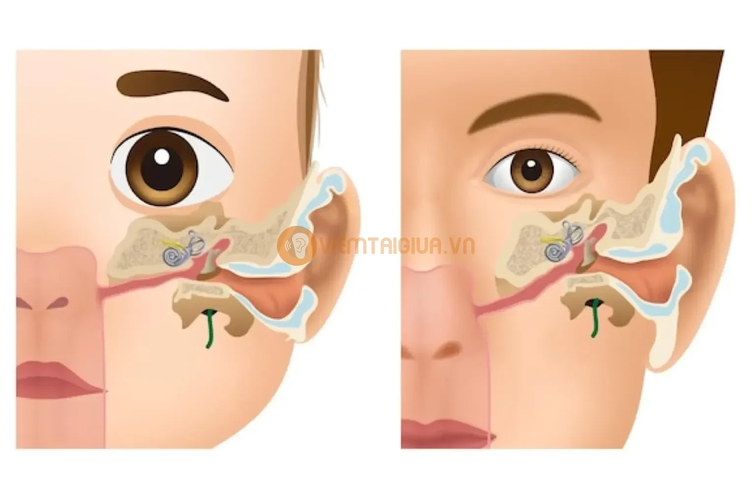 Ở trẻ nhỏ, ống Eustachian thẳng hàng, dẫn tới ống này dễ bị vi khuẩn virus thâm nhập