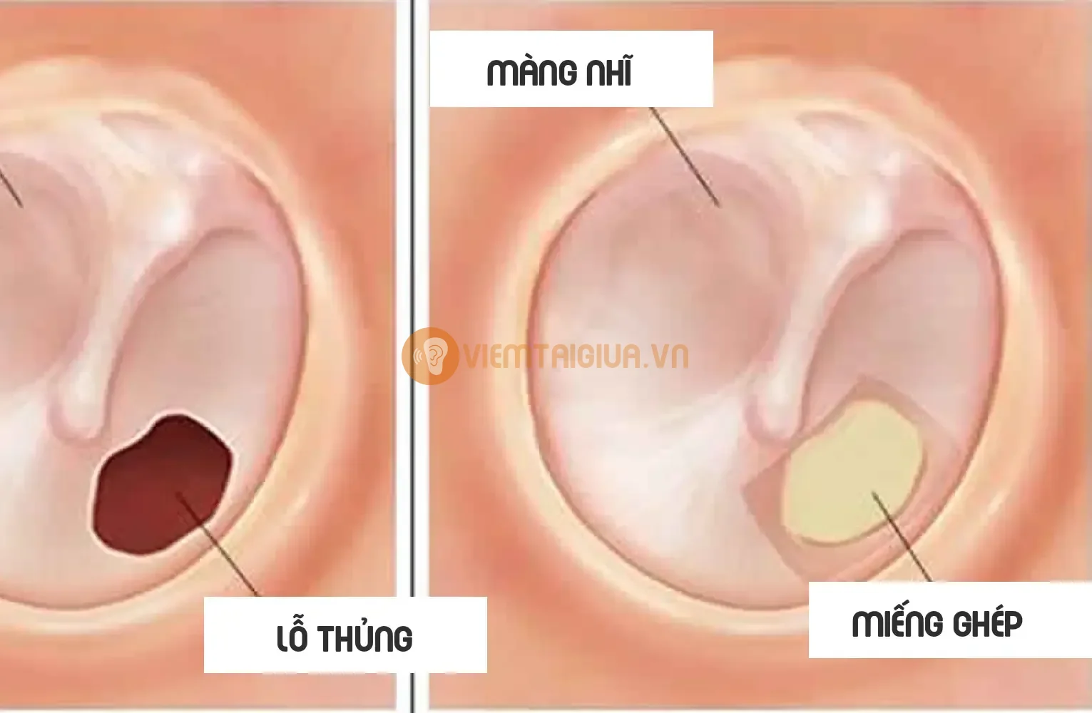 Bác sỹ có thể chỉ định phẩu thuật Myringoplasty nếu vết thủng nhỏ