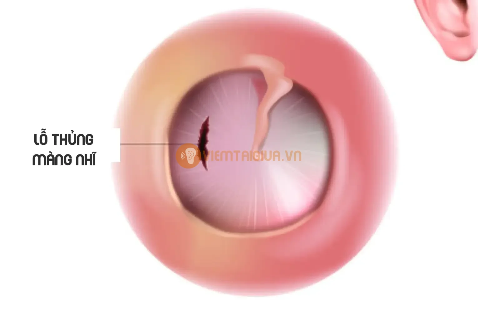 Có nhiều yếu tố ảnh hưởng tới tự lành của màng nhĩ