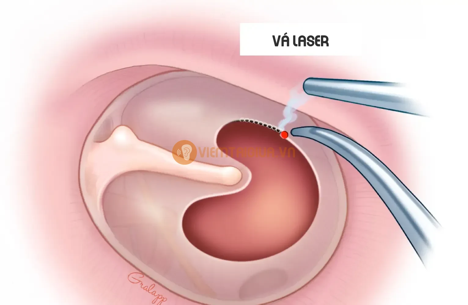 Nếu màng nhĩ không tự lành, bác sỹ có thể phải chỉ định phẫu thuật tympanoplasty