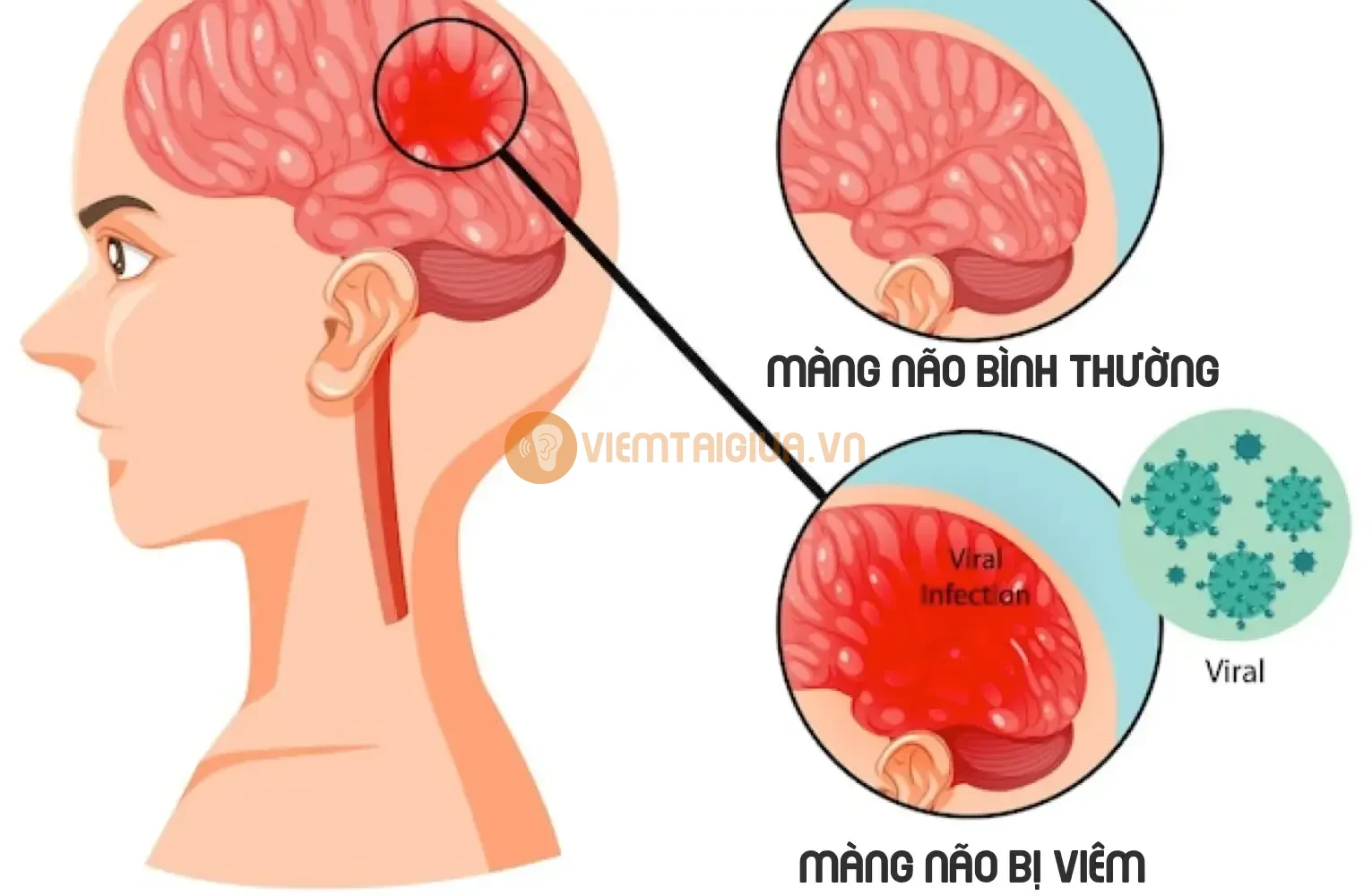 Tiêm vắc xin có thể phòng tránh nhiều biến chứng khi mắc viêm tai giữa