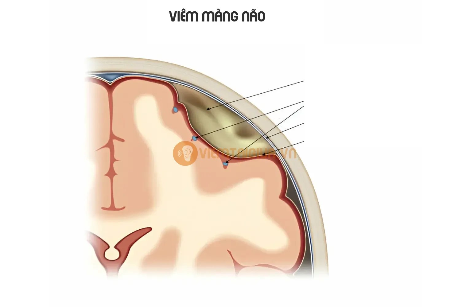 Hình ảnh mô tả áp xe dưới màng cứng