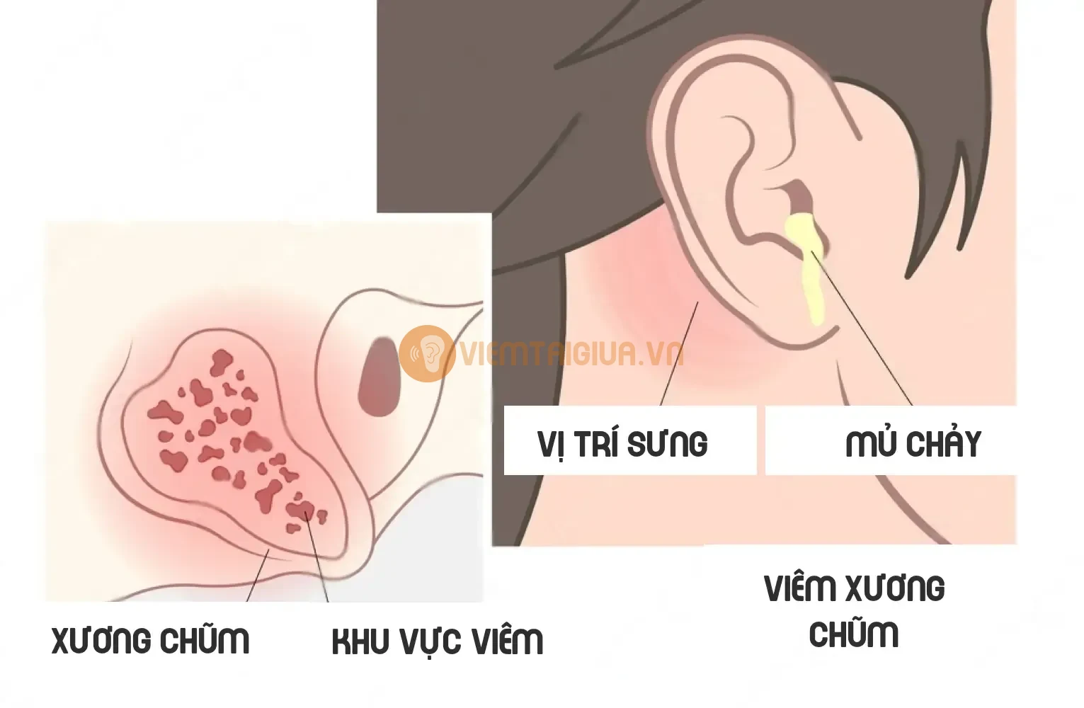 Điều trị viêm xương chũm đòi hỏi một phương pháp tiếp cận toàn diện