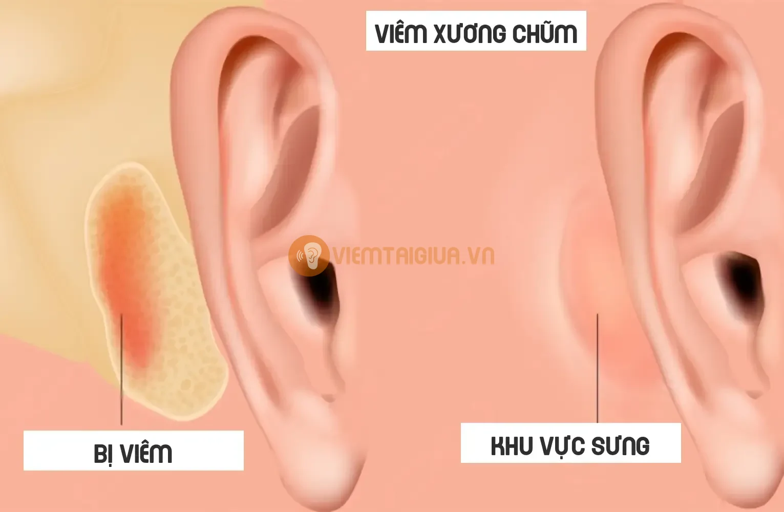 Việc điều trị kịp thời sẽ ngăn ngừa các biến chứng nguy hiểm của viêm tai giữa