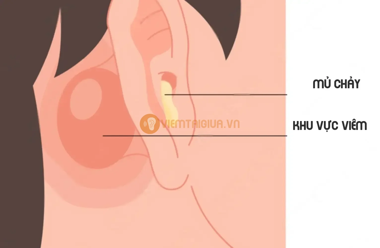 Xương chũm đóng vai trò như một hệ thống thông hơi cho tai giữa, tuy nhiên vùng xương xốp này cũng dễ bị nhiễm trùng