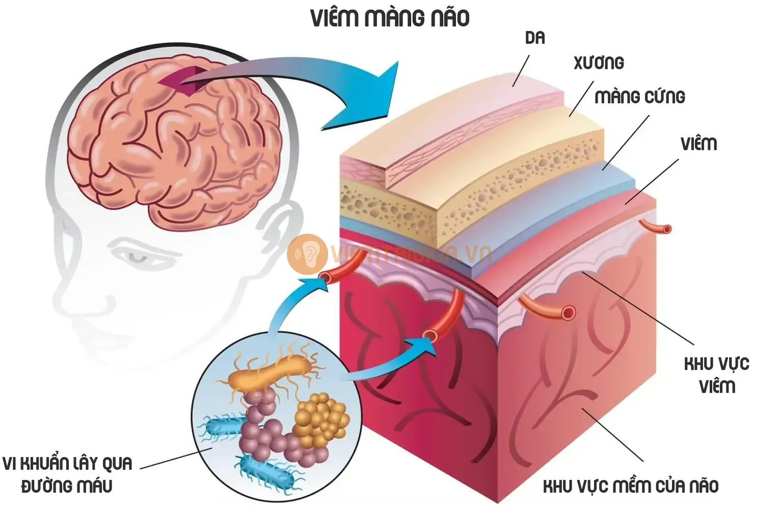 Viêm màng não có thể tử vong nếu không điều trị kịp thời