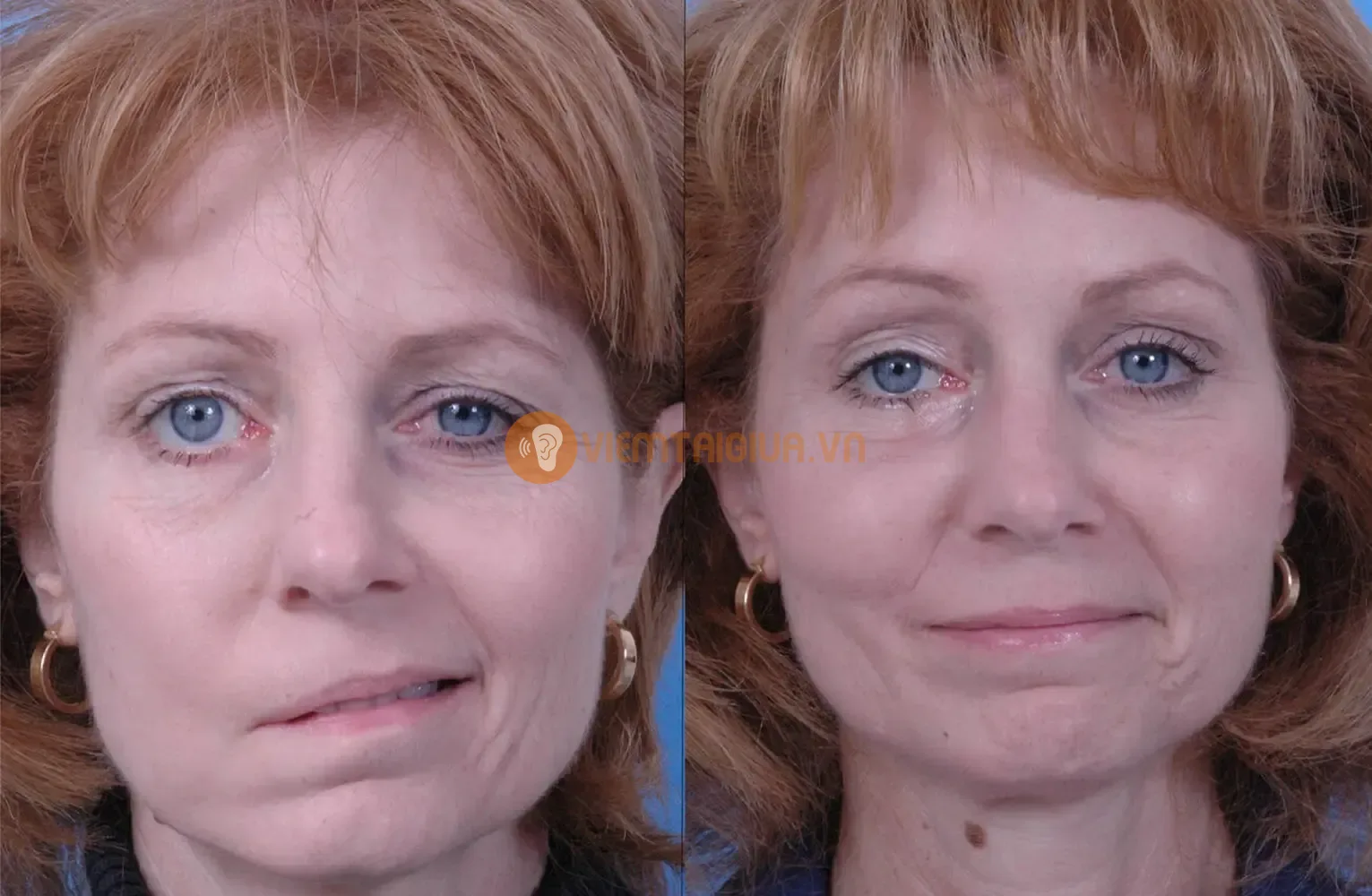 Liệt dây thần kinh mặt gây anh hưởng tới thẩm mỹ, chức năng khuôn mặt