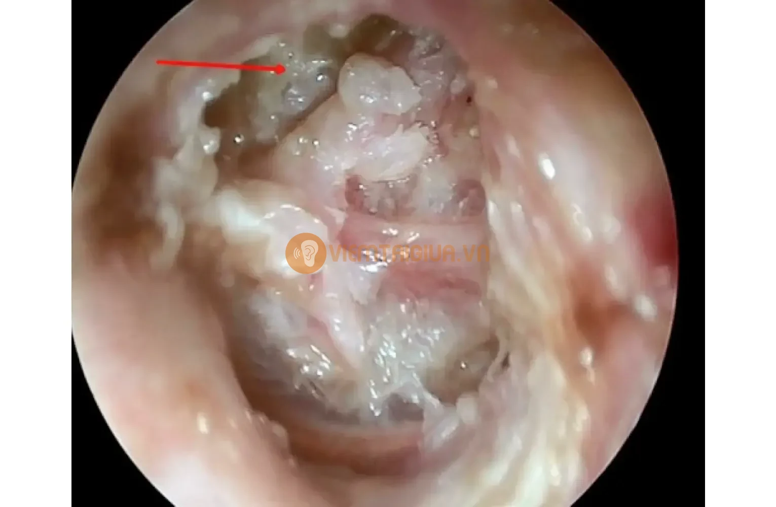 Tình trạng nhiễm trùng ở viêm tai giữa cấp tính tạo thành các nang chứa mủ