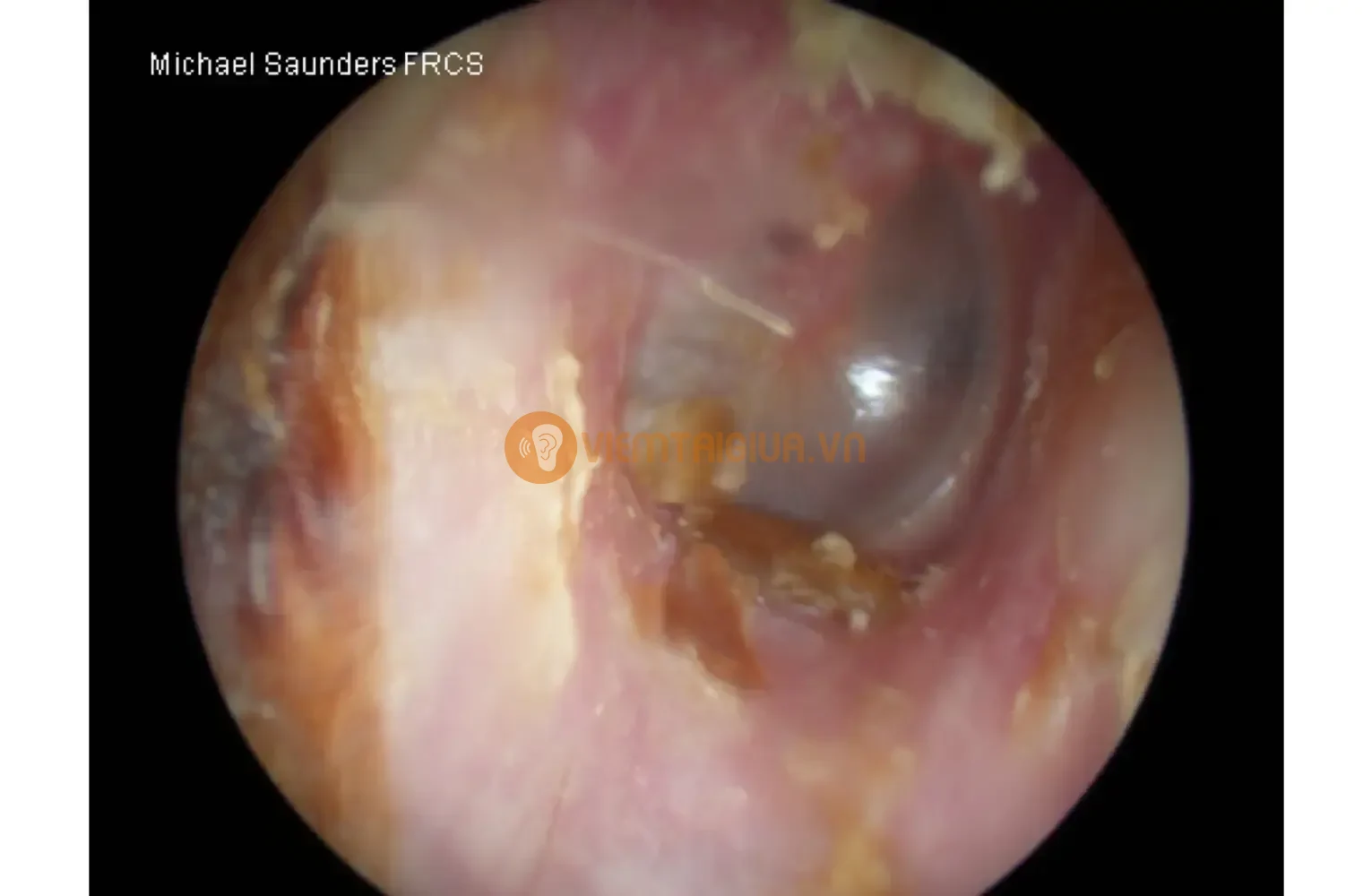 Ống tai chứa các tế bào chết tạo điều kiện thuận lợi cho sự phát triển của nấm gây bệnh