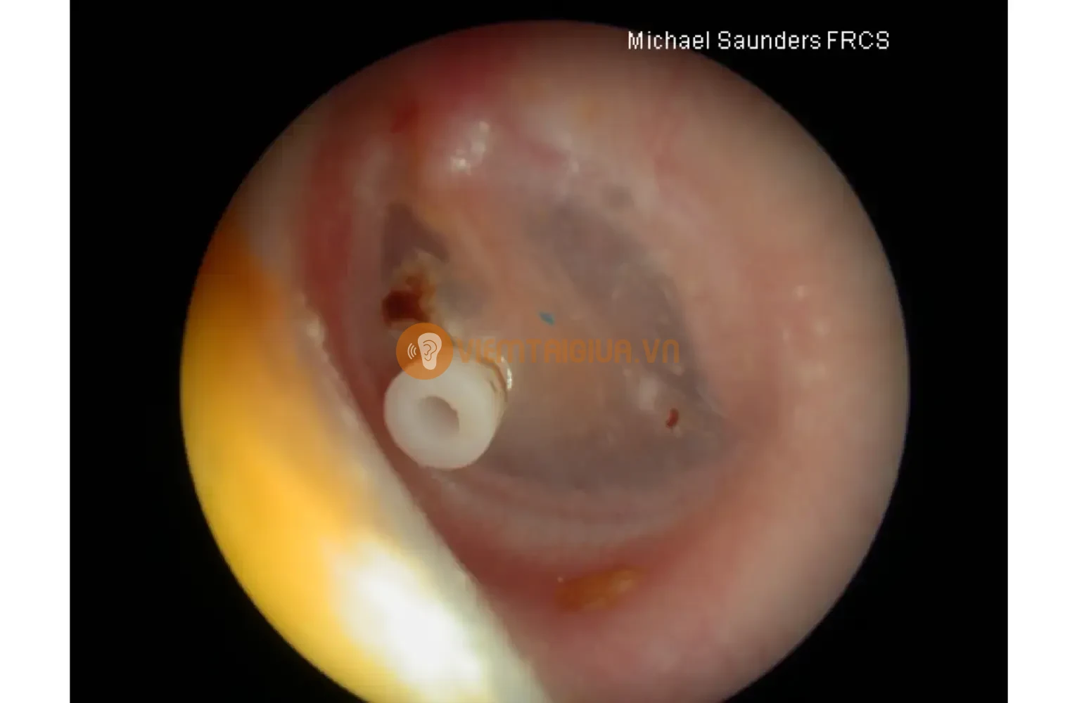 Phẫu thuật đặt ống thông trên màng nhĩ giúp thoát dịch mủ ra ngoài