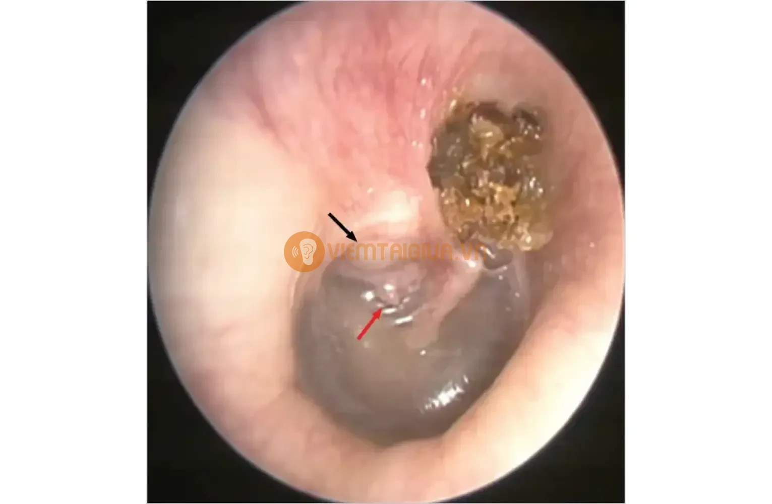 Cholesteatoma thượng nhĩ - khối u bã tai ở phần trên của màng nhĩ