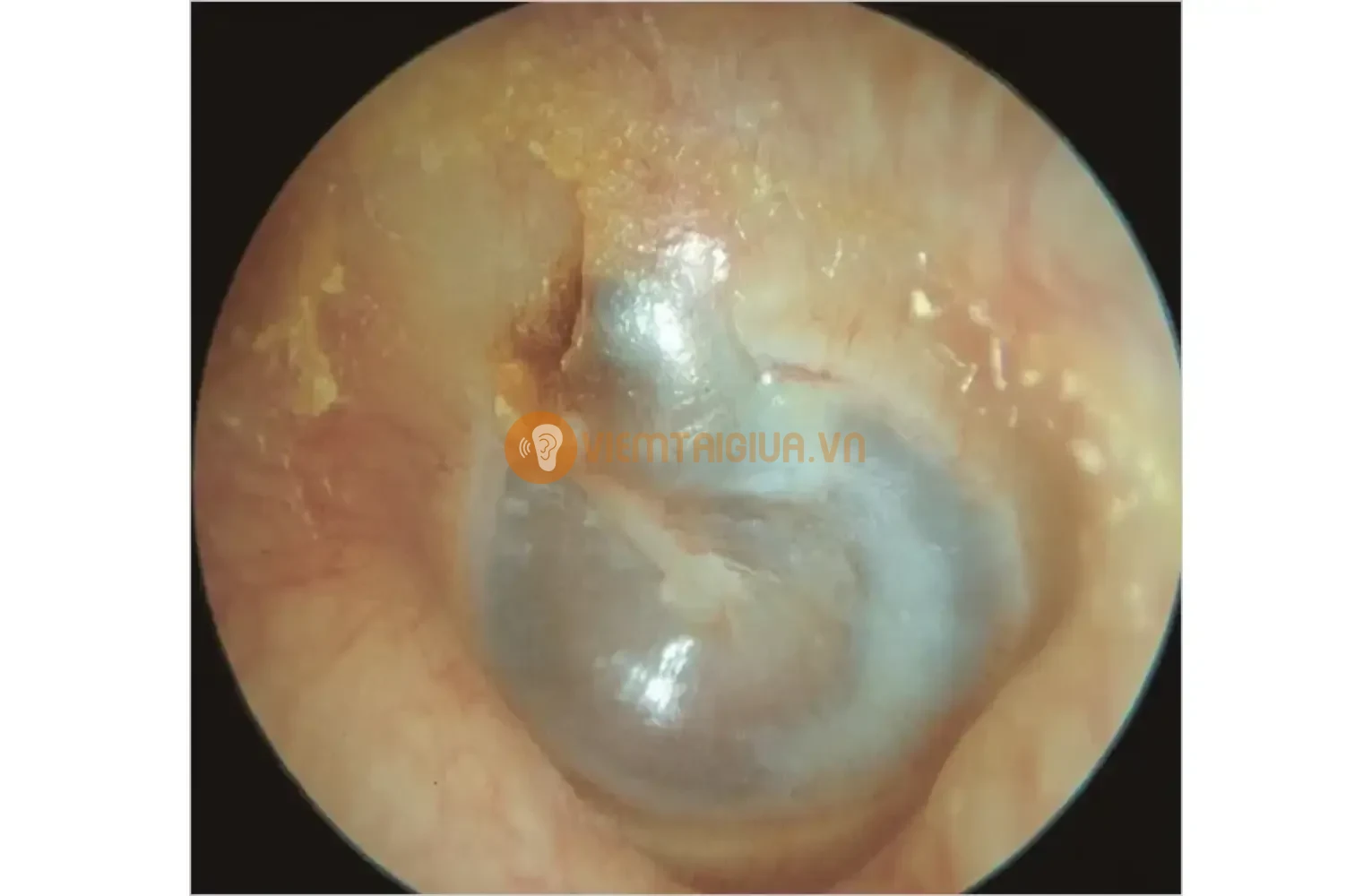 Hiện tượng u bã dạng nang trong tai - Cholesteatoma dạng nang