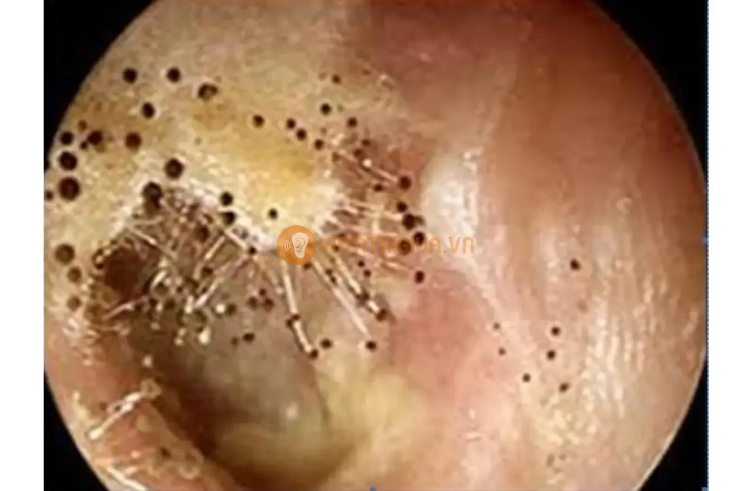 Sự kí sinh của các bào tử nấm ở ống tai ngoài