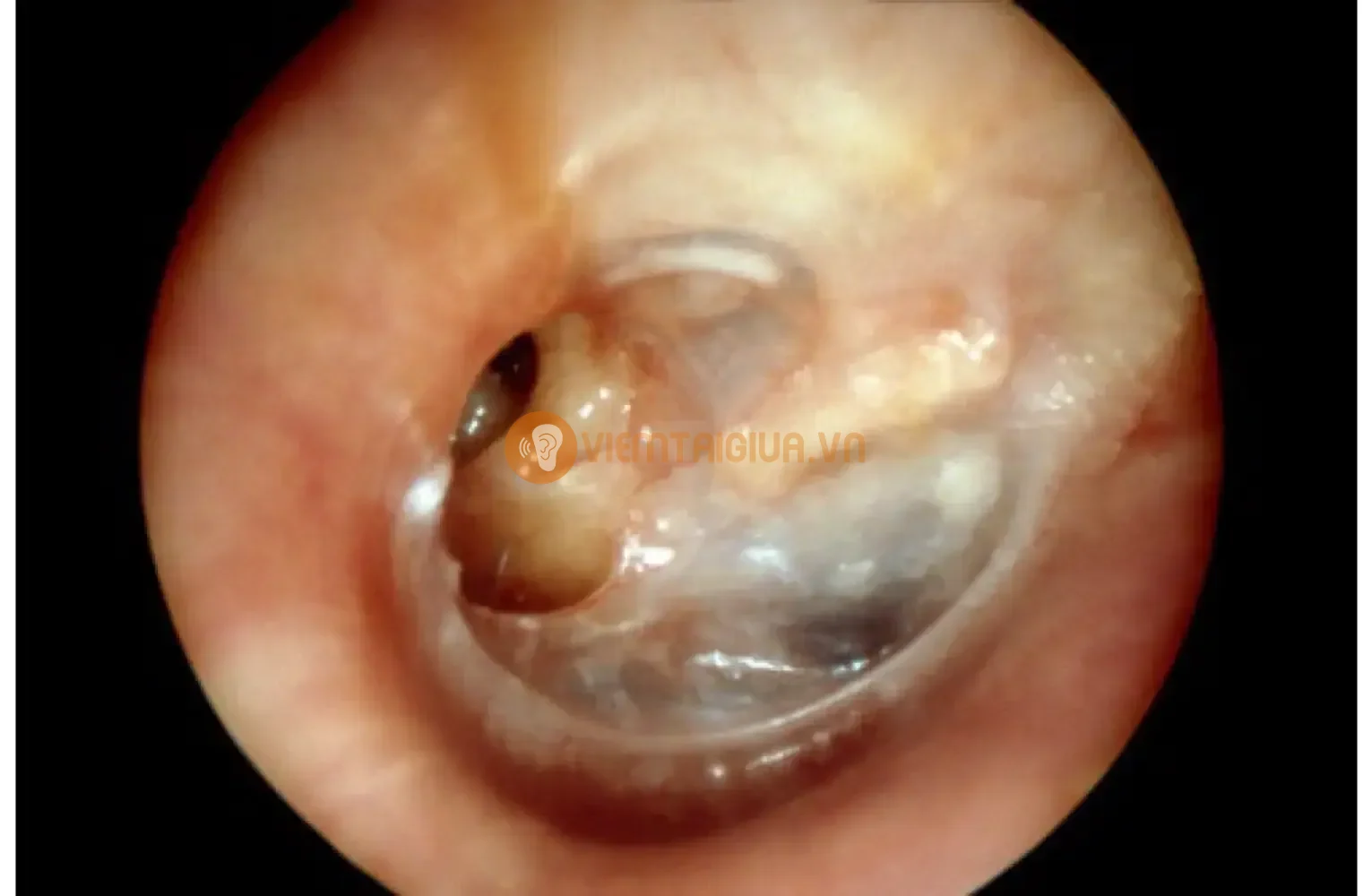 Thủng màng nhĩ do viêm tai giữa cấp tính
