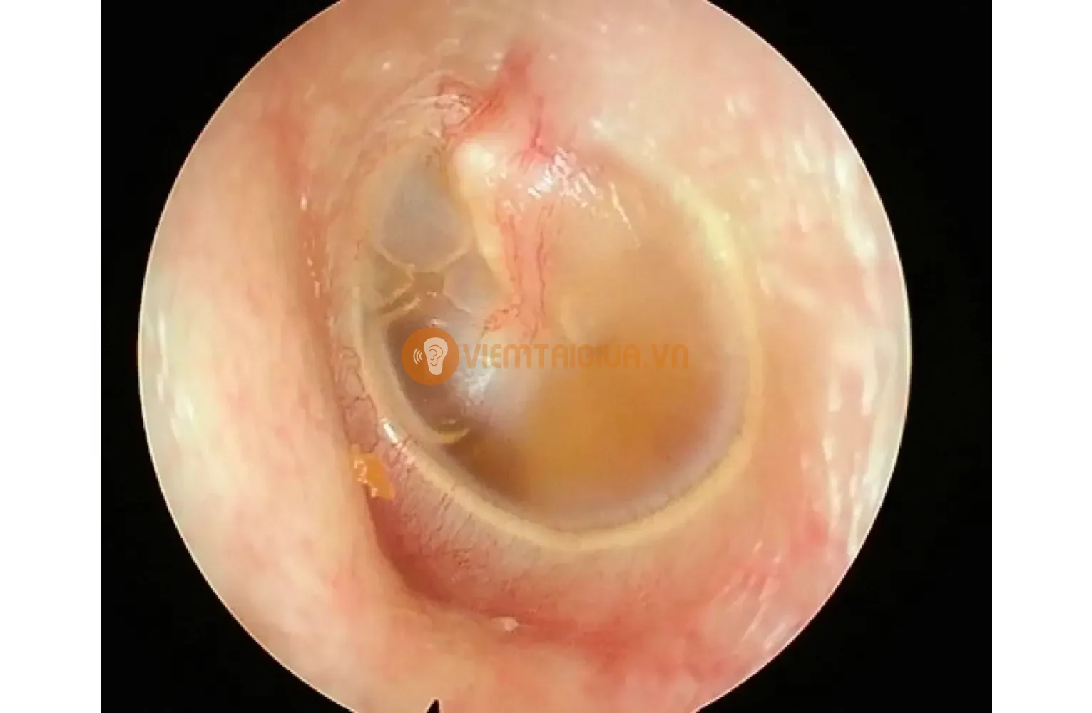 Tích tụ dịch tiết và dịch mủ sau màng nhĩ ở viêm tai giữa thanh dịch