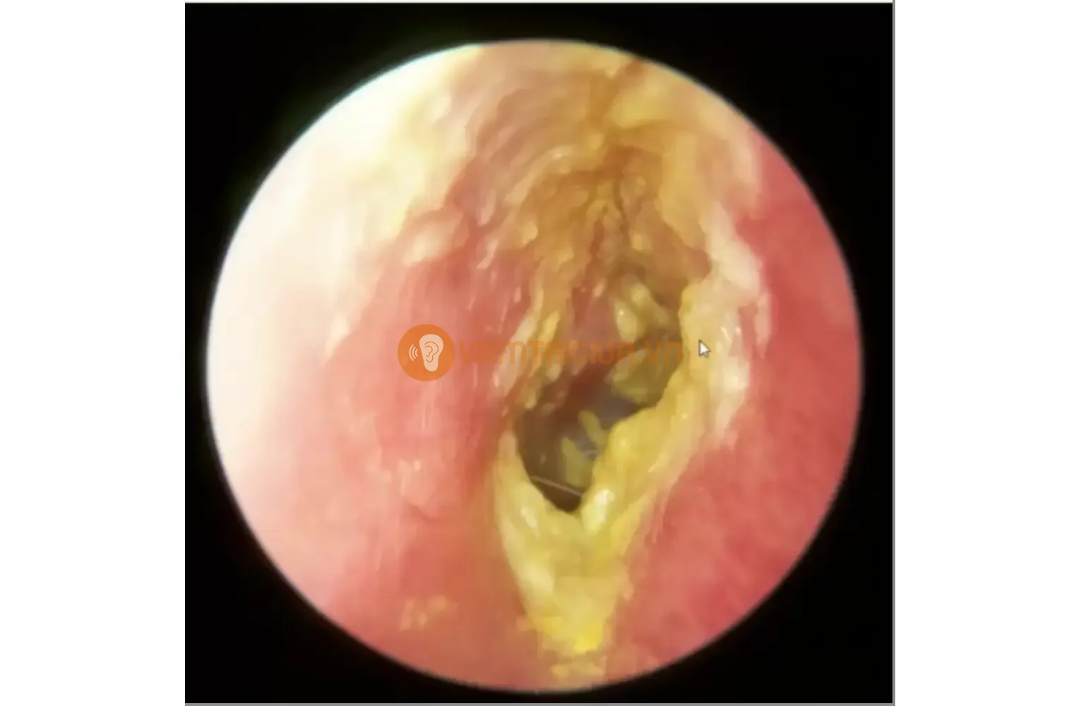 Viêm tai ngoài được chẩn đoán do không vệ sinh tai thường xuyên