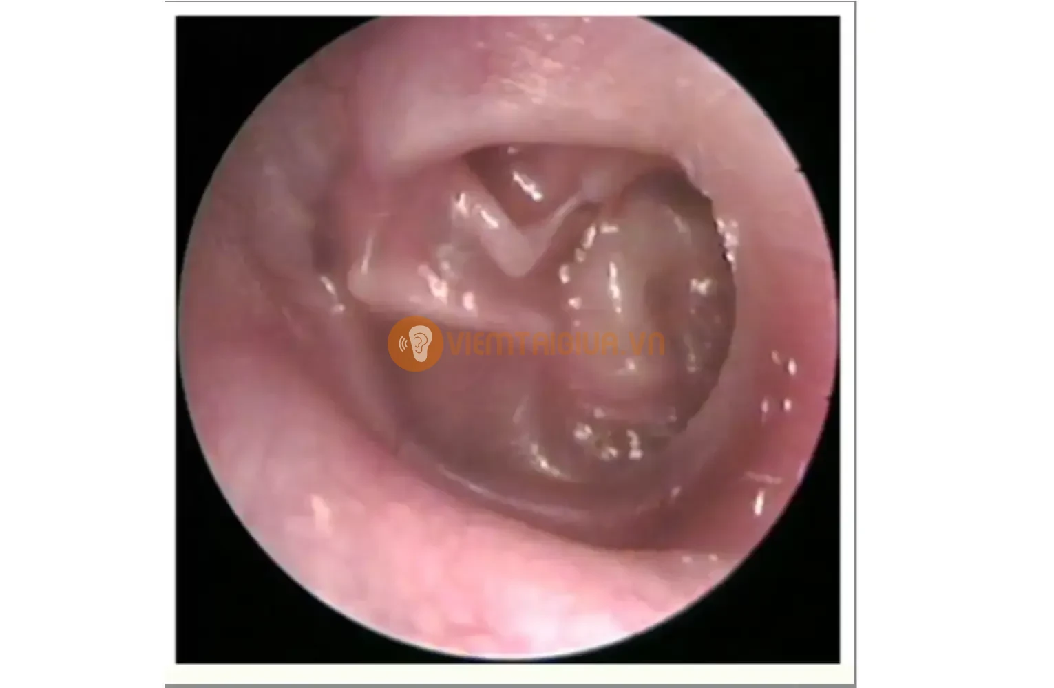 Hiện tượng màng nhĩ co rút do mất cân bằng áp suất trong tai