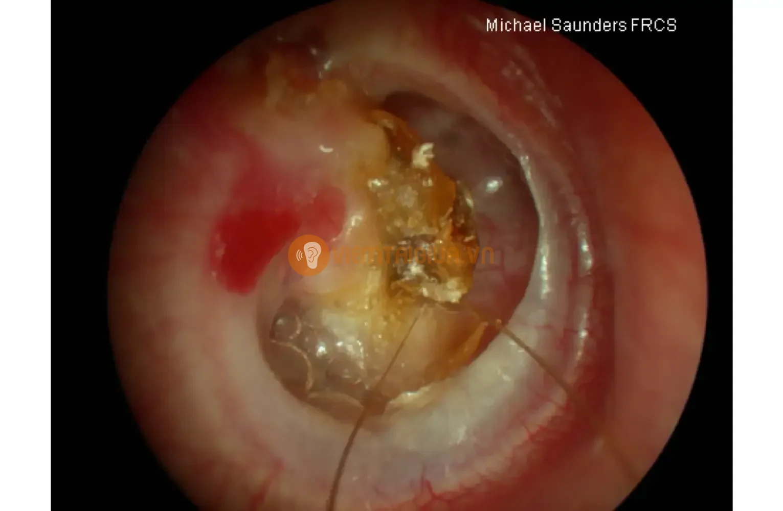 Khối u cholesteatoma chứa tế bào chết và bã nhờn bám chặt trên màng nhĩ