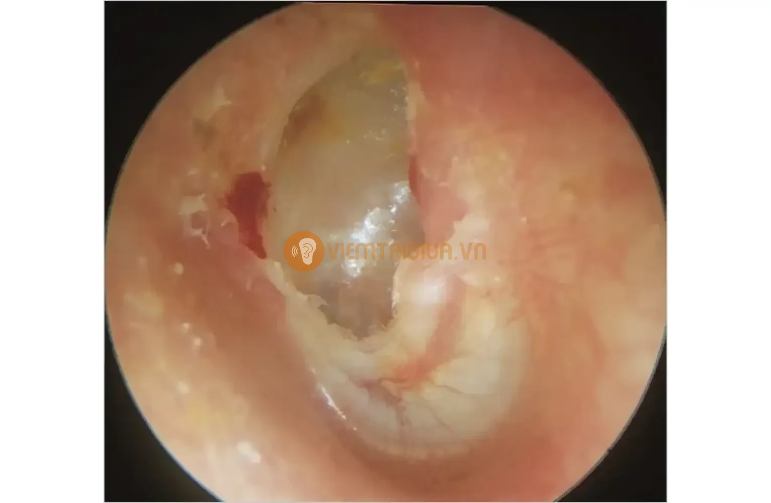 Phẫu thuật biểu bì hóa phần thượng nhĩ và trung nhĩ