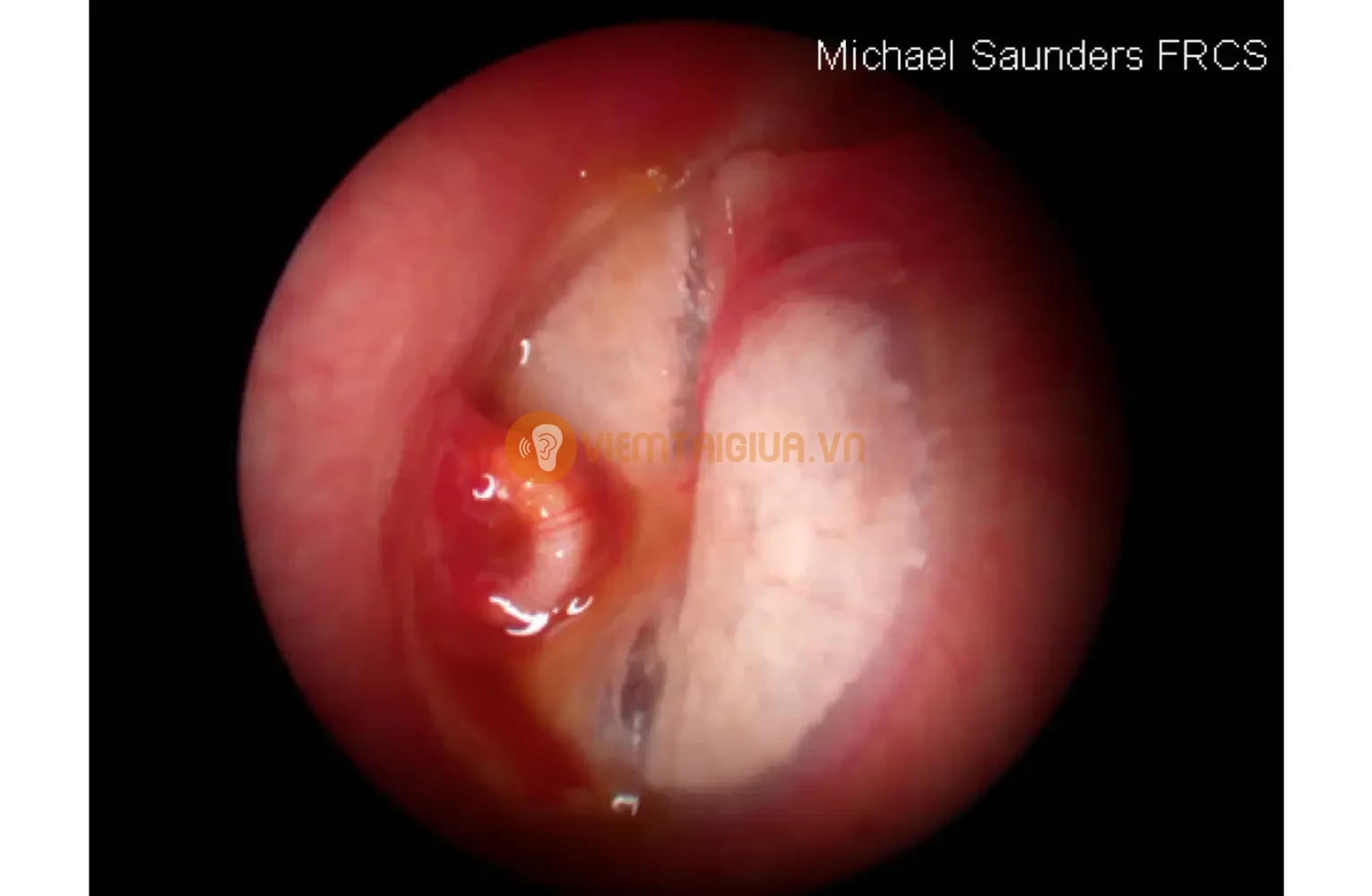 Hiện tượng tắc ông thông màng nhĩ hậu phẫu