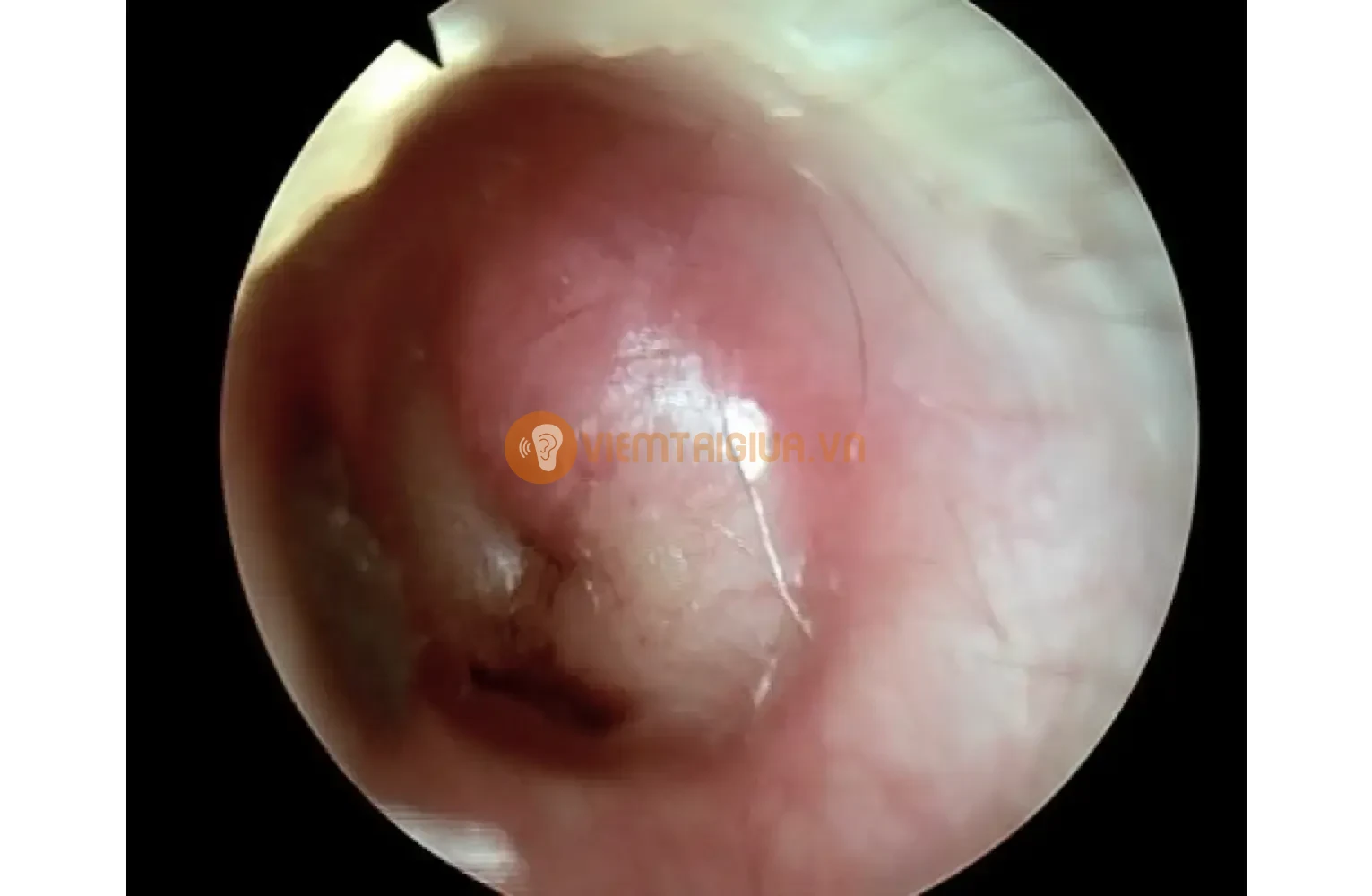 Hình ảnh màng nhĩ tích tụ dịch mủ gây ra bởi bệnh lý viêm tai giữa cấp tính do vi khuẩn