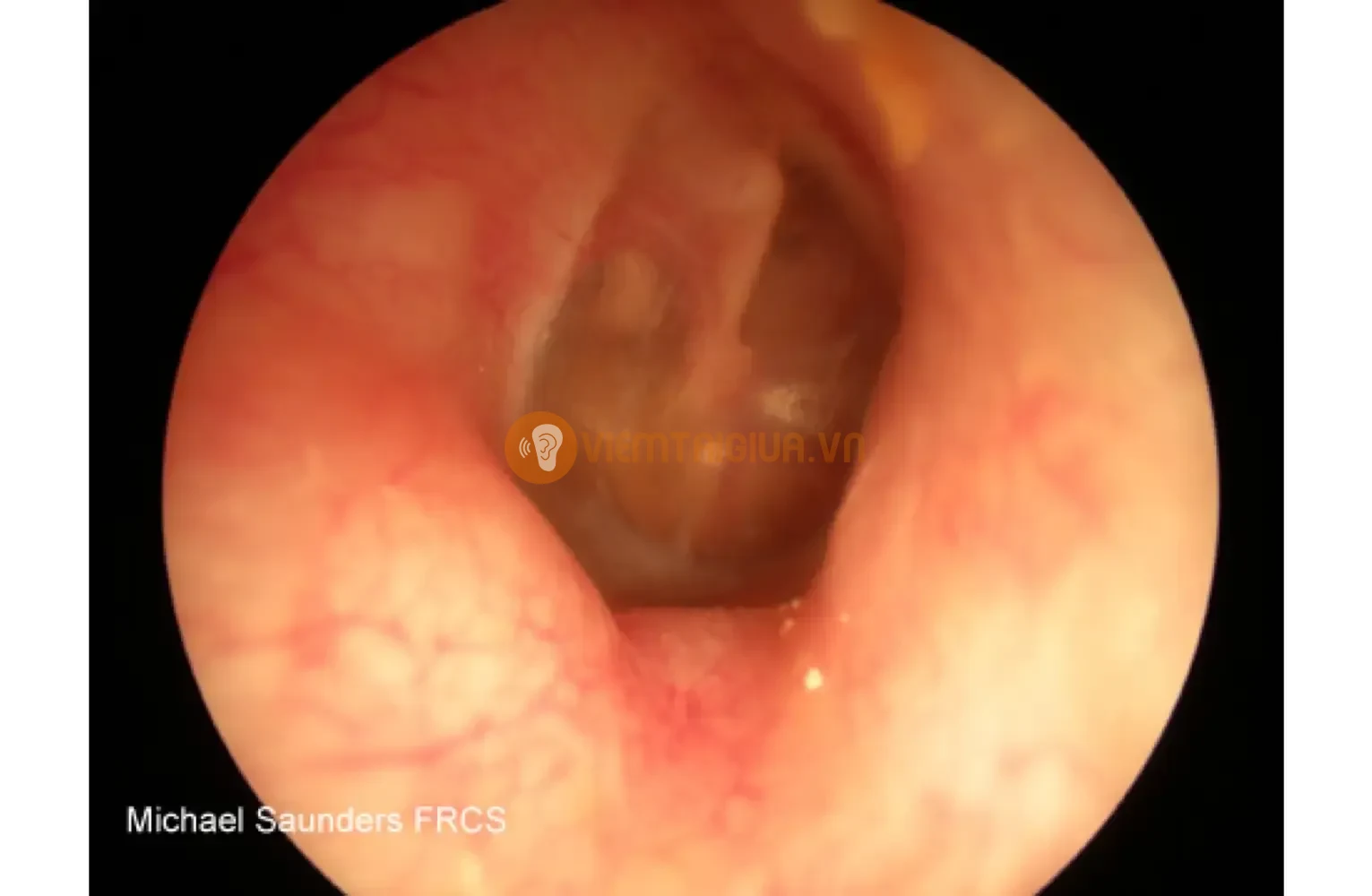 Viêm ống tai ngoài có các túi dịch ở phần ống tai