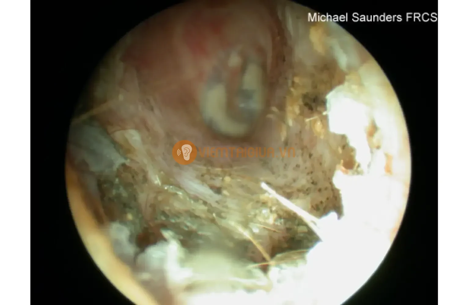 Hình ảnh các bào tử nấm kí sinh ở ống tai ngoài