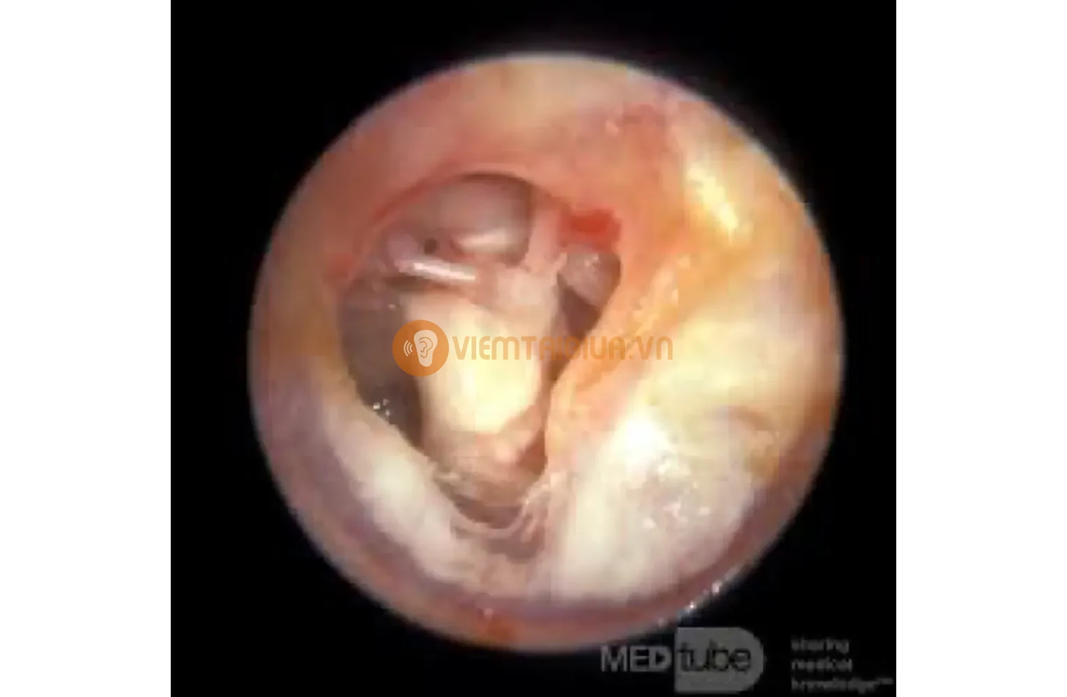 Thủng màng nhĩ và xơ hóa do ứ đọng cặn canxi